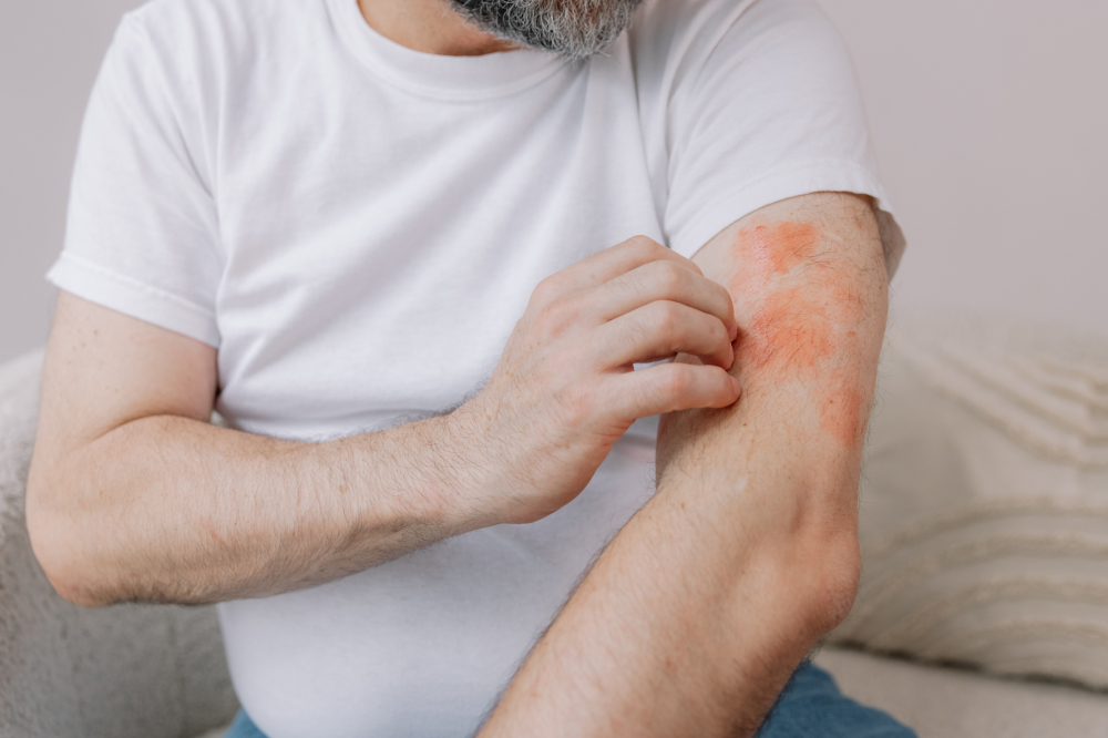 3 ways for managing eczema symptoms